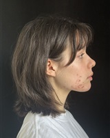 pola profil droit acné<br />&copy; Rany DOMENECH