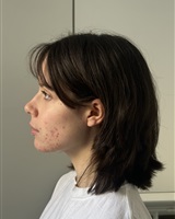 pola profil gauche acné<br />&copy; Rany DOMENECH